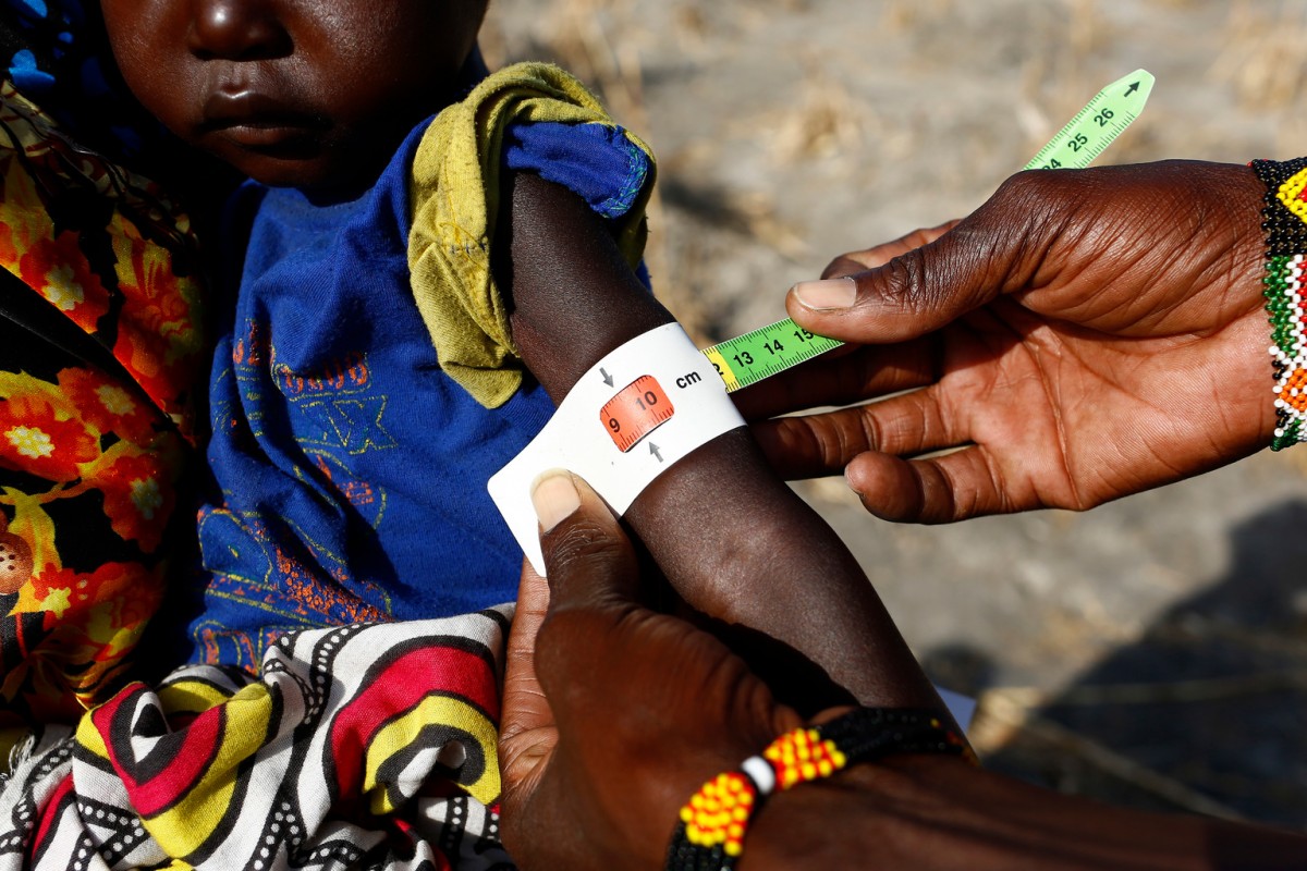 Angelina Nyanin, 25, holds her niece, Nyalel Gatcauk, 2,  who suffers from malnutrition,  as a UNICEF nutrition worker measures her arm during a Rapid Response Mechanism (RRM) mission in Thonyor, Leer county, South Sudan, February 26, 2017.  Angelina has five children of her own. They come from a village called Waluk, a two hours walk from the WFP registration area. Armed men killed her husband last year during a raid. Nyalel is the daughter of her brother. Angelina explained how in August last year her village was attacked by what she said were government soldiers. In the incident the soldiers took the mother of Nyalel away. She has never returned. She now provides for Nyalel as a mother. SheÕs alone, taking care of six children. The father of Nyalel is in Khartoum. ÒWhen they attacked the village I managed to run away with my children into the bush. When I returned at night Nyalel was in the house, but her mother was gone. The armed men that came for us that day and killed people randomly. They burned down many houses. Food and insecurity are our biggest worries. Because of the fighting that is going on around us it is difficult to find food. We are forced to collect and eat water lilies from the swamp. But the children donÕt react well to them. They loose weight quickly. I wish I could give my children a normal life. I wish I could send them to school, buy new clothes for them. I wish I could see them play outside the house during the day. But this is not possible now. The war has ruined everything in our livesÓ, Angelina explains. In areas affected by insecurity and cut off from humanitarian assistance, including Leer, Koch and Manyedit counties, UNICEF, in collaboration with World Food Programme and partners, are working to reach the most vulnerable children with acute malnutrition through Rapid Response Missions and to re-establish static services in areas with relative calm. Further missions are planned in the coming days and weeks to address the nutritio