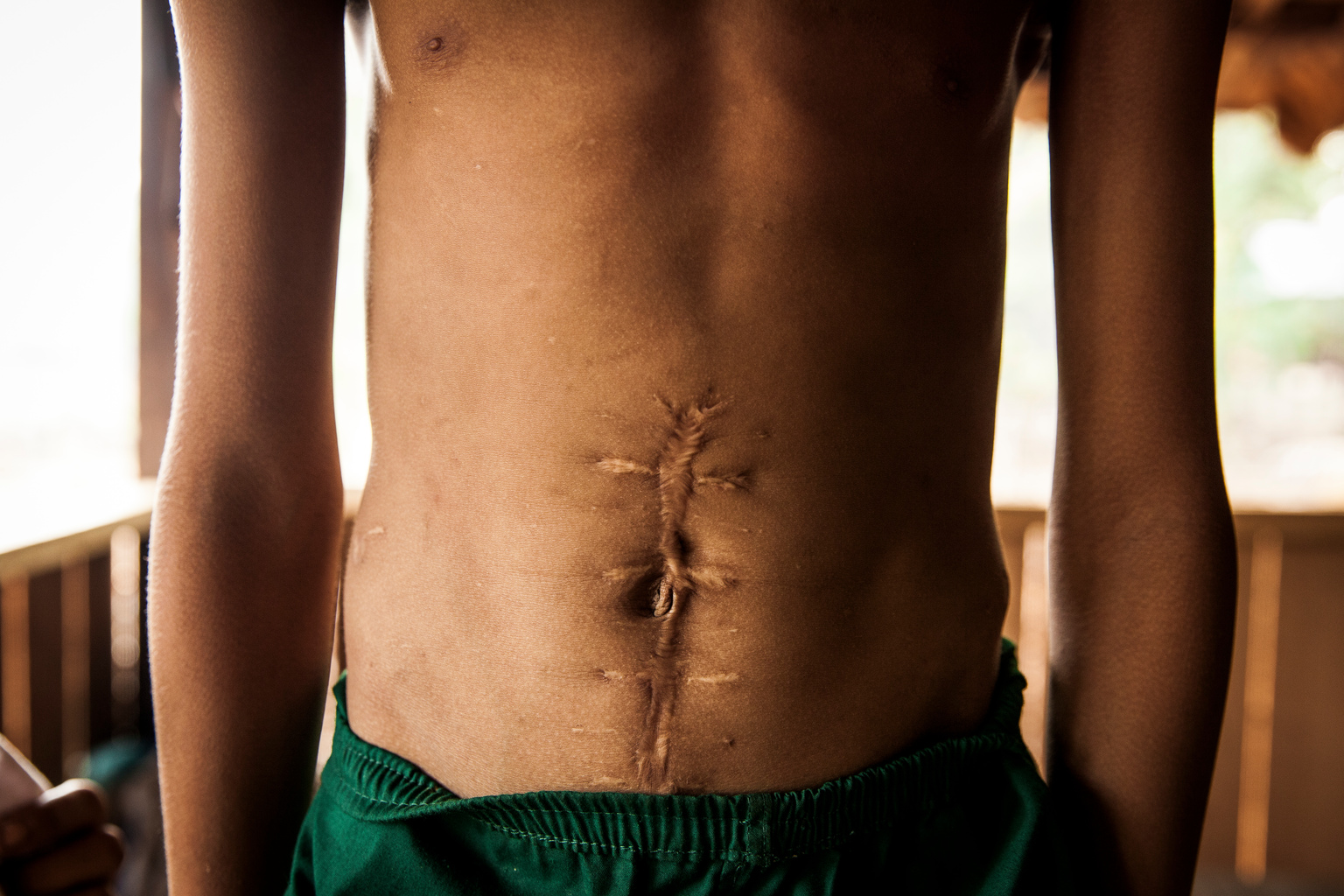 Min Thiya, 10, shows a large scar from injuries he sustained two-years ago when he and a group of his friends were playing with unexploded ordnance that killed his friend So Aung Myo Win instantly and injured four others, including Min, at the Ann Ka Law village in Kayin State in Myanmar, Monday 3 April 2017. In 2017, working with the Government of Myanmar, UNICEF will strive to meet the basic needs of the most vulnerable internally displaced children. Myanmar is experiencing three protracted humanitarian crises, each with its own set of complex underlying factors. In Rakhine State, inter-communal violence that erupted in 2012 continues to plague 120,000 internally displaced people spread across 40 camps or informal sites, as well as host communities. Eighty per cent of the displaced are women and children. In Kachin State, armed conflict that reignited in 2011 continues to impact communities caught in the crossfire between an ethnic armed group and the Myanmar army. Nearly 87,000 people remain displaced as a result, including 40 per cent who are in areas outside of government control. An additional 11,000 people remain displaced in northern Shan State, where a similar conflict broke out in 2011. Compounding the protracted crises are issues related to religious and/or ethnic discrimination, exploitation, chronic poverty, vulnerability to natural disasters, statelessness, trafficking and humanitarian access. In addition to the humanitarian crises in Rakhine, Kachin and Shan states, Myanmar is impacted by humanitarian situations in other parts of the country, including natural disasters, health emergencies and small-scale displacements.